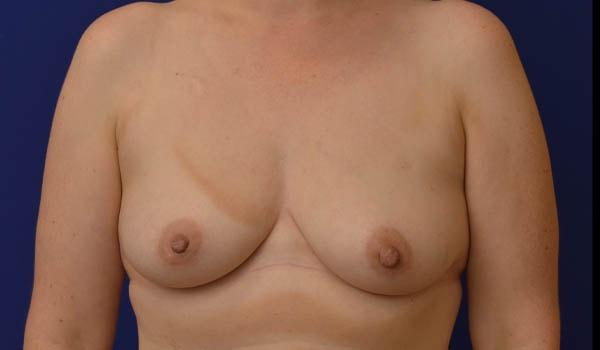 Breast Lift before at Advanced Plastic Surgery in Grand Rapids, MI