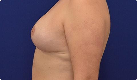 Breast Reduction after at Advanced Plastic Surgery in Grand Rapids, MI