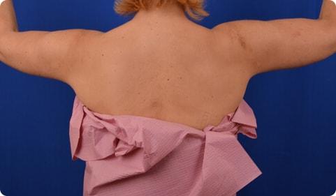 Arm Lift after at Advanced Plastic Surgery in Grand Rapids, MI