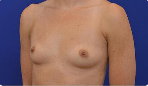 Breast Augmentation before at Advanced Plastic Surgery in Grand Rapids, MI