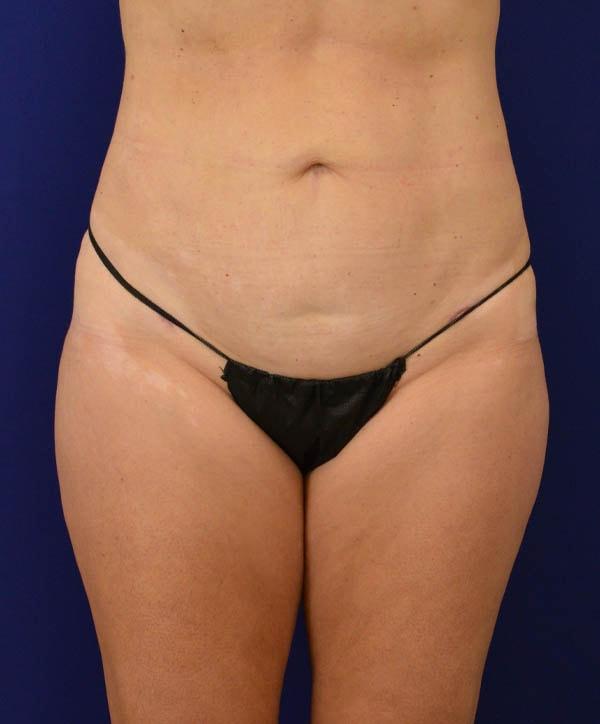 Brazilian Butt Lift after at Advanced Plastic Surgery in Grand Rapids, MI