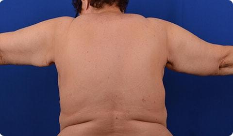 Arm Lift after at Advanced Plastic Surgery in Grand Rapids, MI