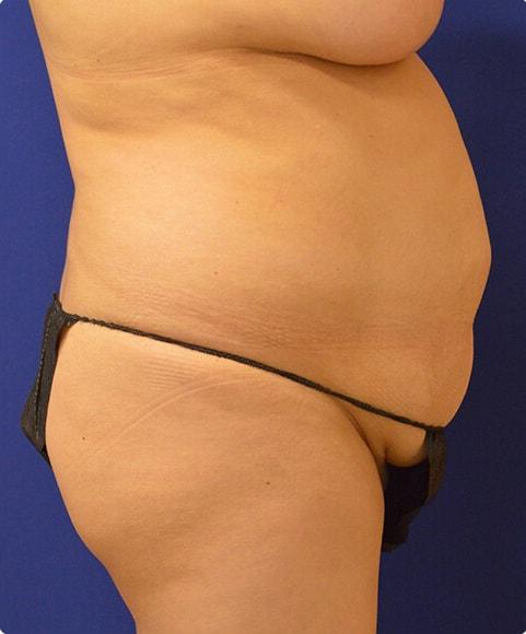 Liposuction before at Advanced Plastic Surgery in Grand Rapids, MI