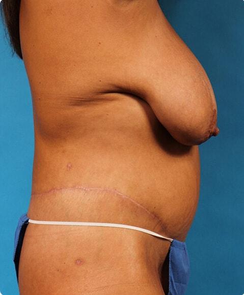CoolSculpting after at Advanced Plastic Surgery in Grand Rapids, MI