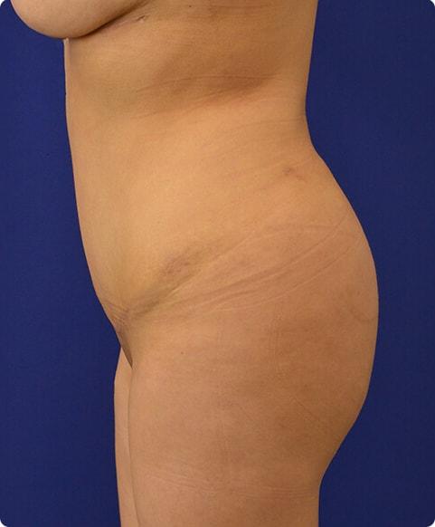 Advanced Plastic Surgery bbl after — Grand Rapids, MI