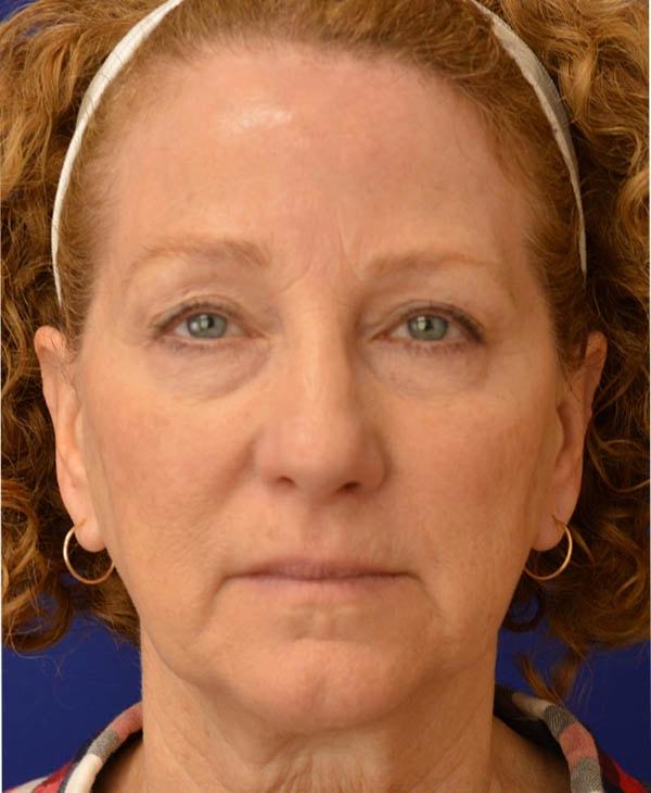 Facelift before at Advanced Plastic Surgery in Grand Rapids, MI