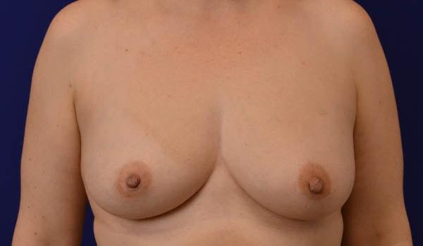 Breast Lift after at Advanced Plastic Surgery in Grand Rapids, MI