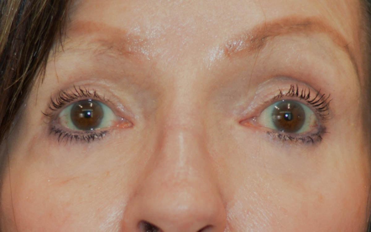 Advanced Plastic Surgery eyelid lift after — Grand Rapids, MI