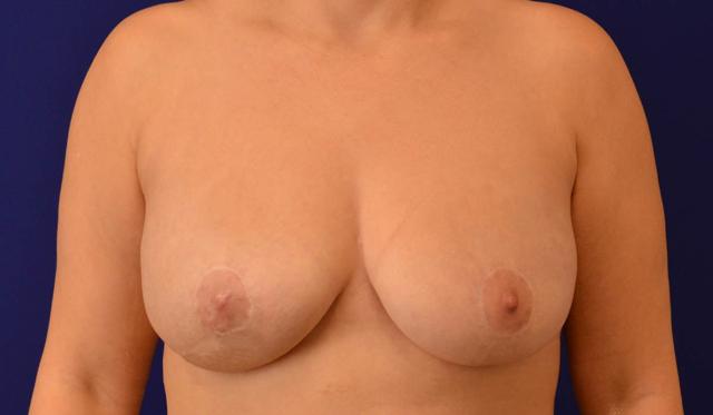 Breast Lift after at Advanced Plastic Surgery in Grand Rapids, MI