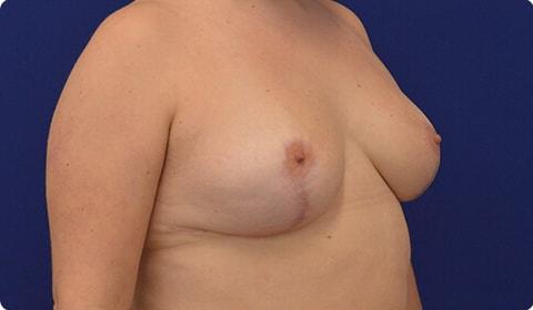 Breast Lift after at Advanced Plastic Surgery in Grand Rapids, MI