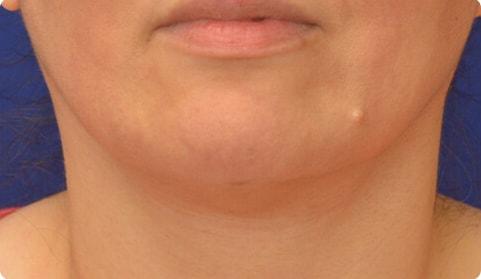 Neck Liposuction after at Advanced Plastic Surgery in Grand Rapids, MI