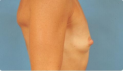 Breast Augmentation before at Advanced Plastic Surgery in Grand Rapids, MI
