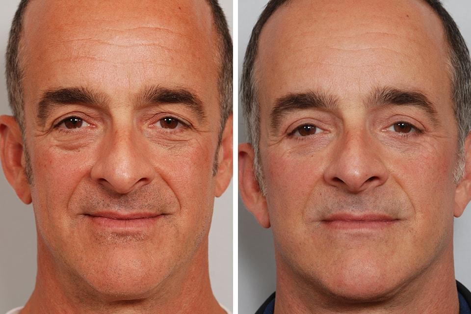 David B. Rosenberg, MD facelift result — New York, NY