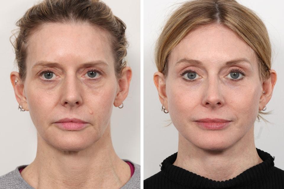 David B. Rosenberg, MD facelift result — New York, NY