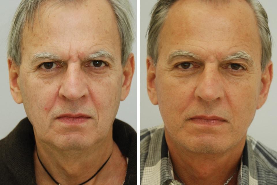 David B. Rosenberg, MD facelift result — New York, NY