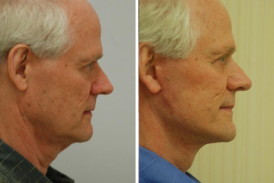 David B. Rosenberg, MD facelift result — New York, NY