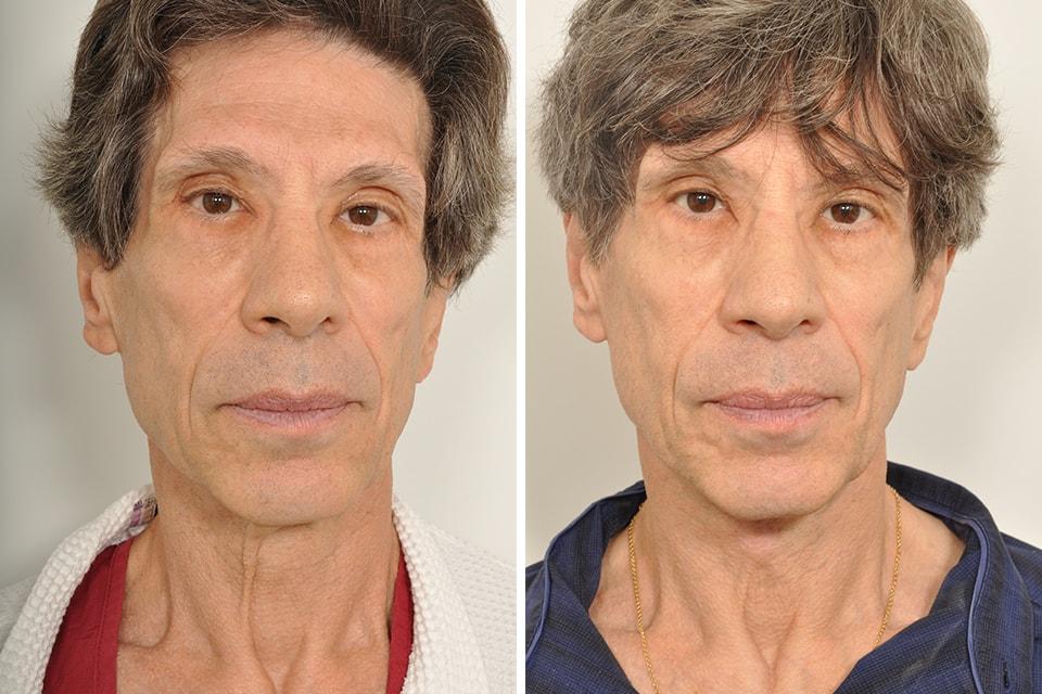 David B. Rosenberg, MD neck lift result — New York, NY