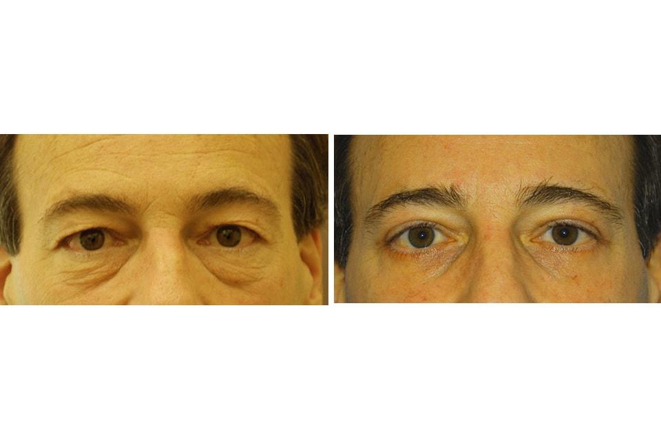 David B. Rosenberg, MD eyelid lift result — New York, NY