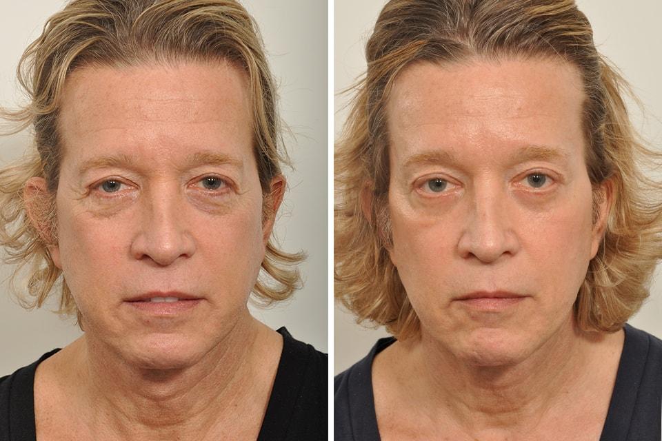 David B. Rosenberg, MD facelift result — New York, NY