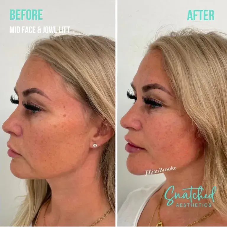 Snatched Aesthetics result — American Fork, UT