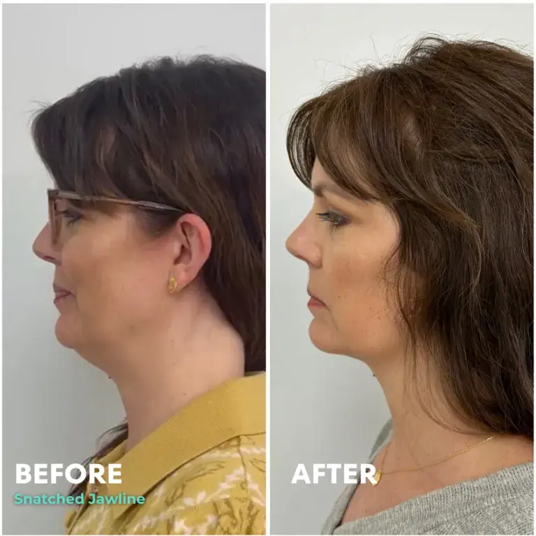 Snatched Aesthetics result — American Fork, UT