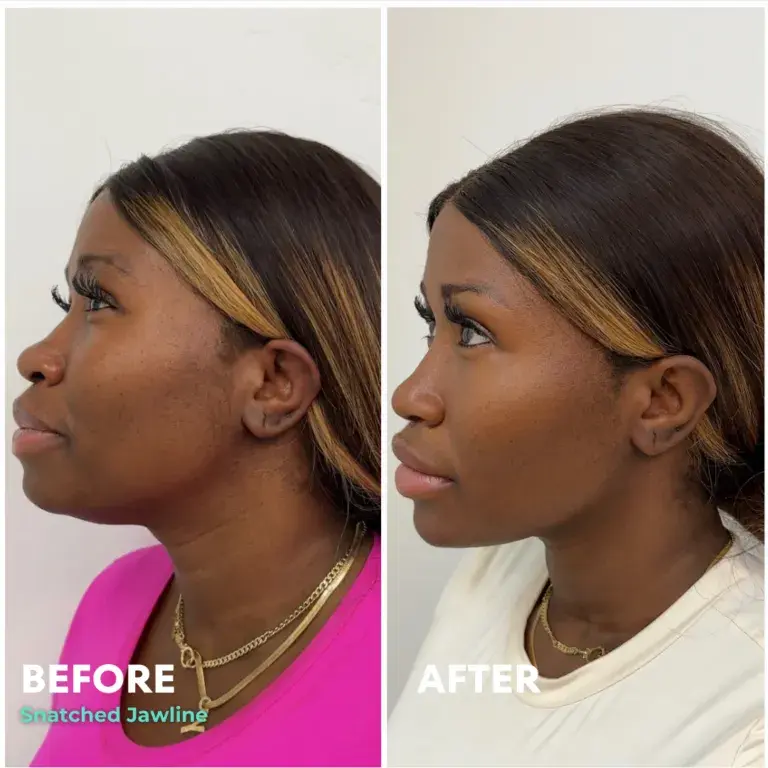 Snatched Aesthetics result — American Fork, UT