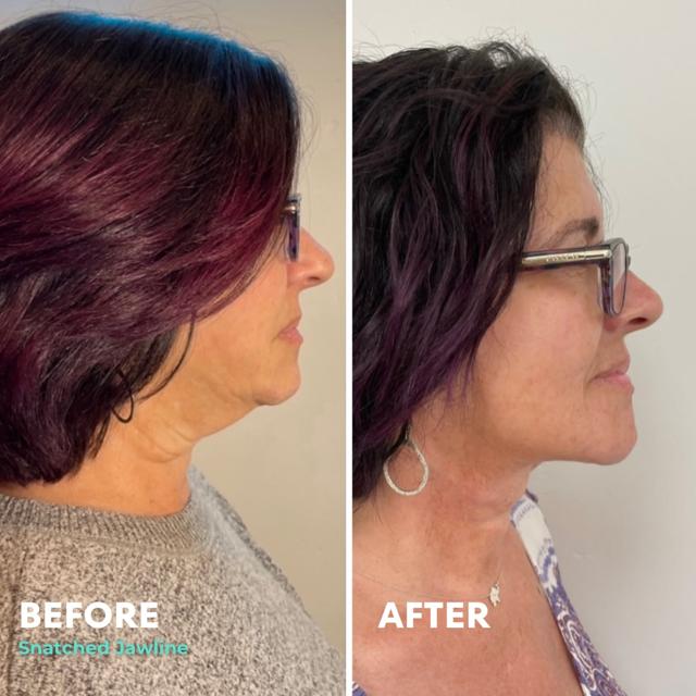 Kybella result at Snatched Aesthetics in American Fork, UT