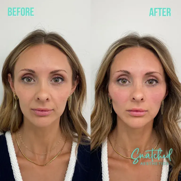Snatched Aesthetics result — American Fork, UT
