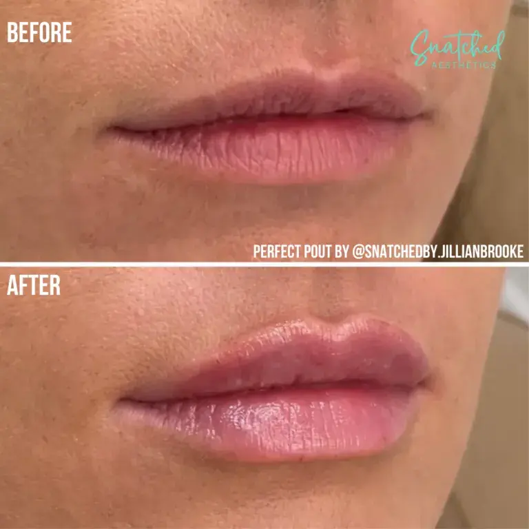 Snatched Aesthetics lip filler result — American Fork, UT