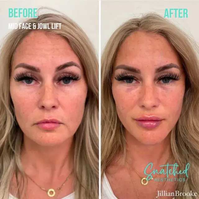 Dermal Fillers result at Snatched Aesthetics in American Fork, UT