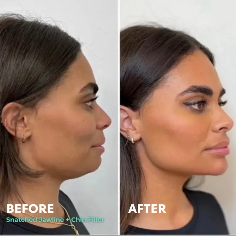 Snatched Aesthetics jawline filler result — American Fork, UT