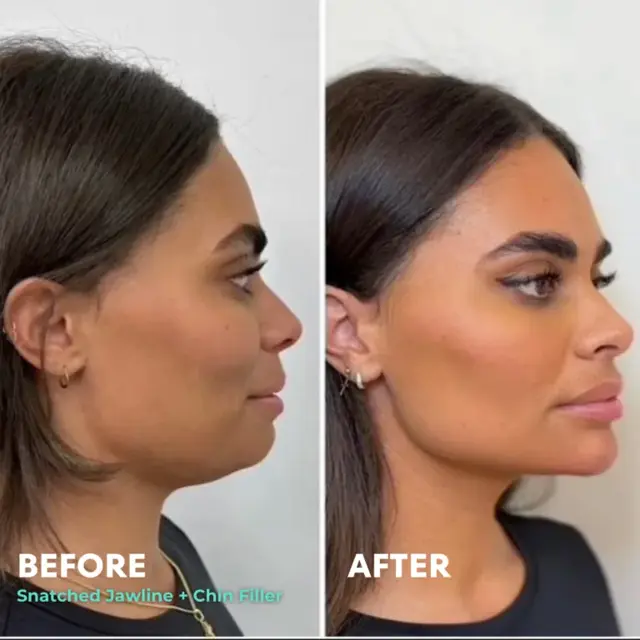 Jawline Filler result at Snatched Aesthetics in American Fork, UT