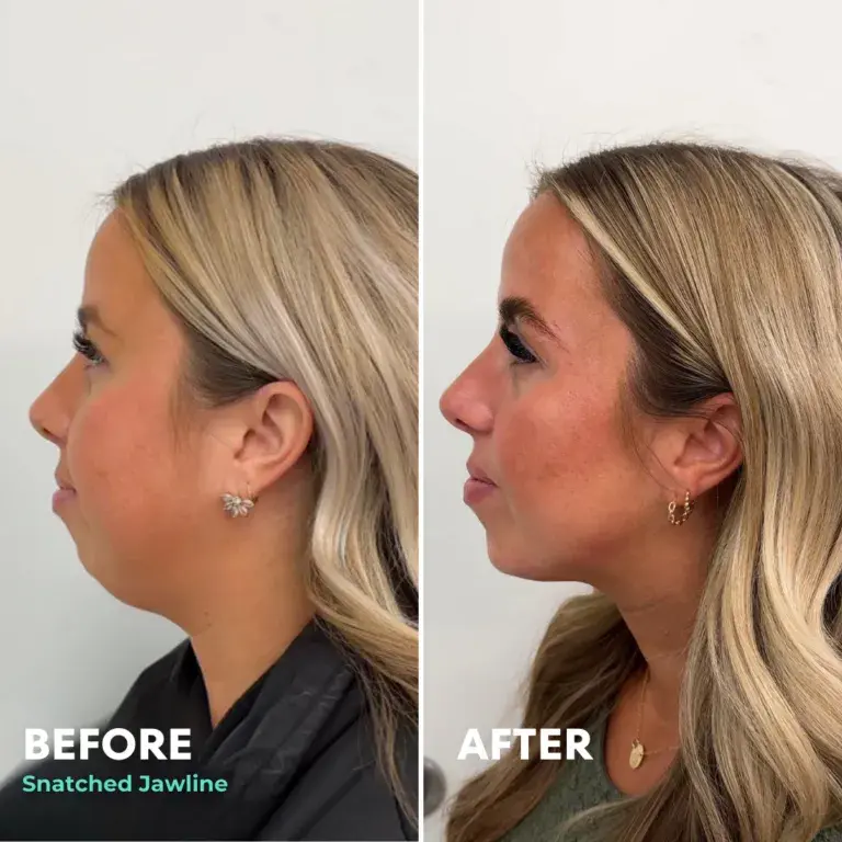 Snatched Aesthetics jawline filler result — American Fork, UT
