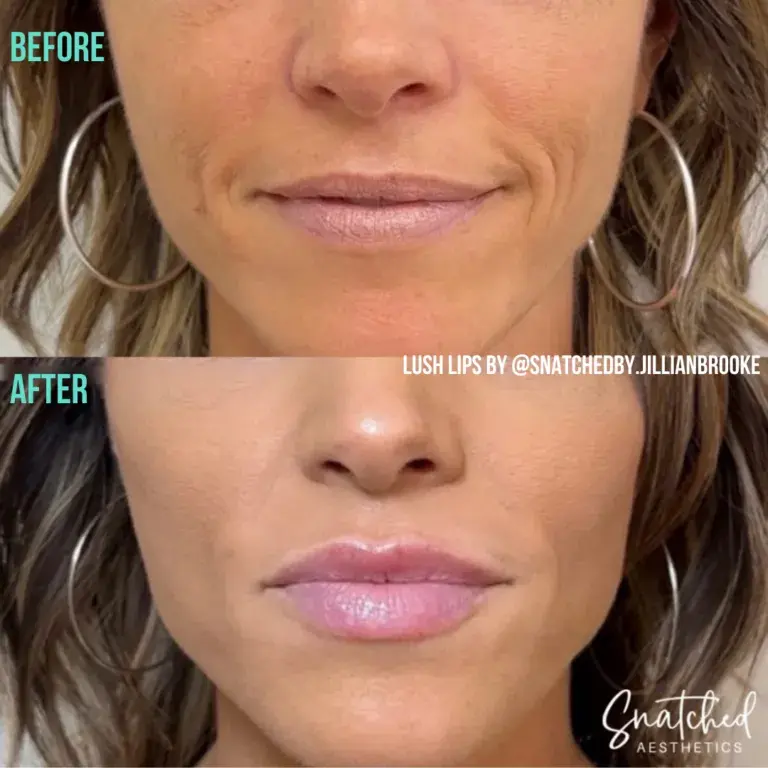 Snatched Aesthetics lip filler result — American Fork, UT