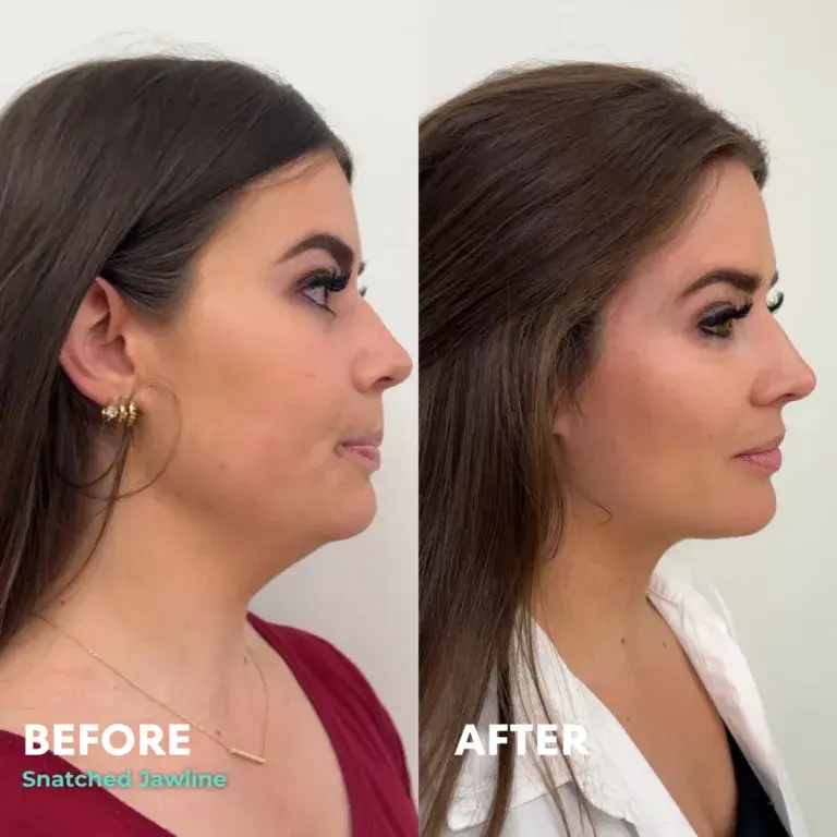Snatched Aesthetics jawline filler result — American Fork, UT