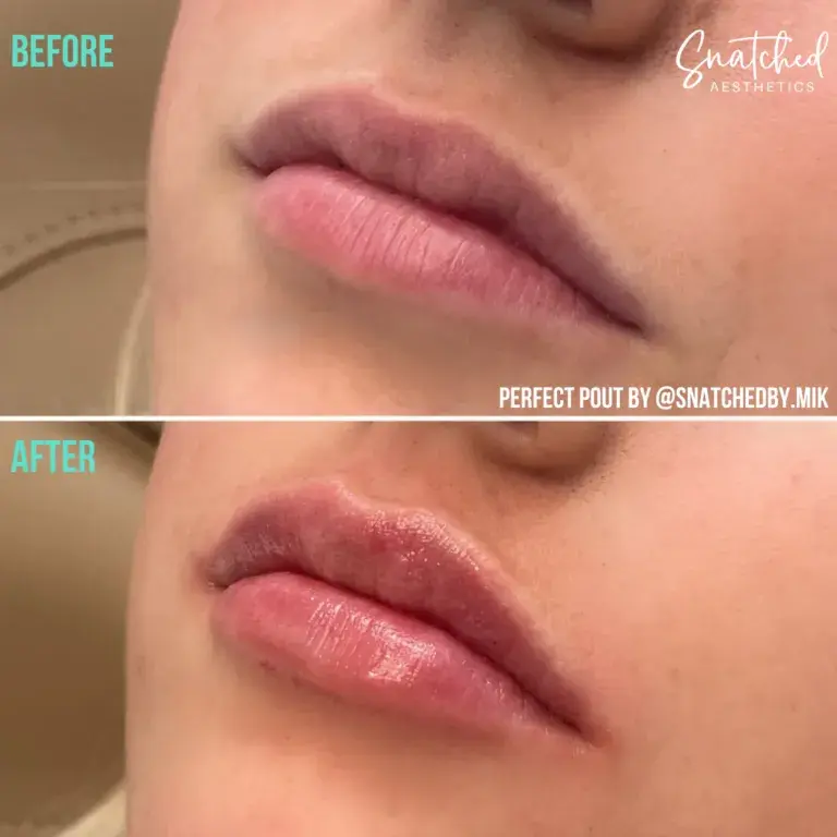 Snatched Aesthetics lip filler result — American Fork, UT