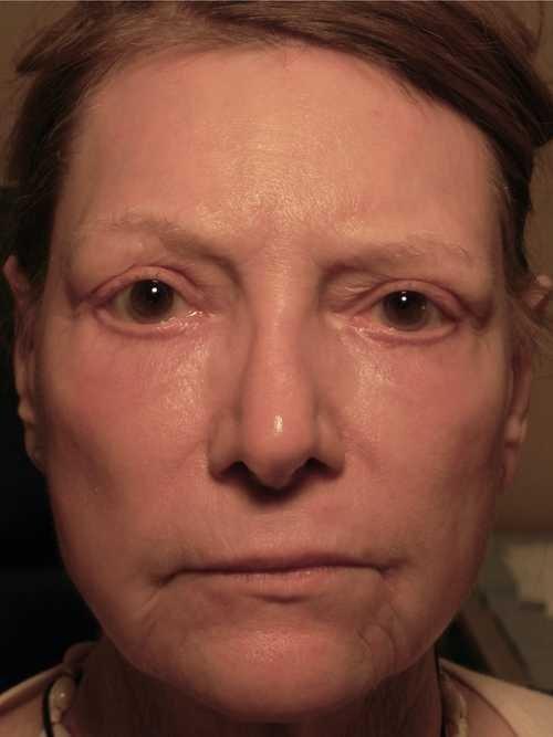 Adam Scheiner, MD laser treatment after — Tampa, FL