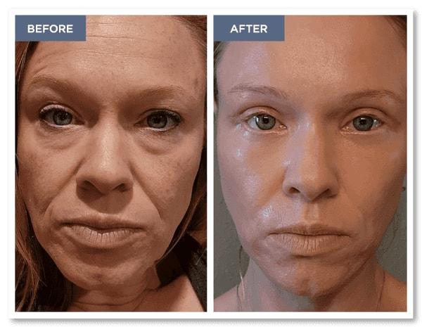 Laser Skin Resurfacing result at Adam Scheiner, MD in Tampa, FL