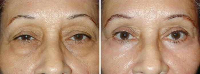 Adam Scheiner, MD eyelid lift result — Tampa, FL