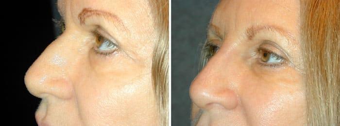 Adam Scheiner, MD liquid rhinoplasty result — Tampa, FL