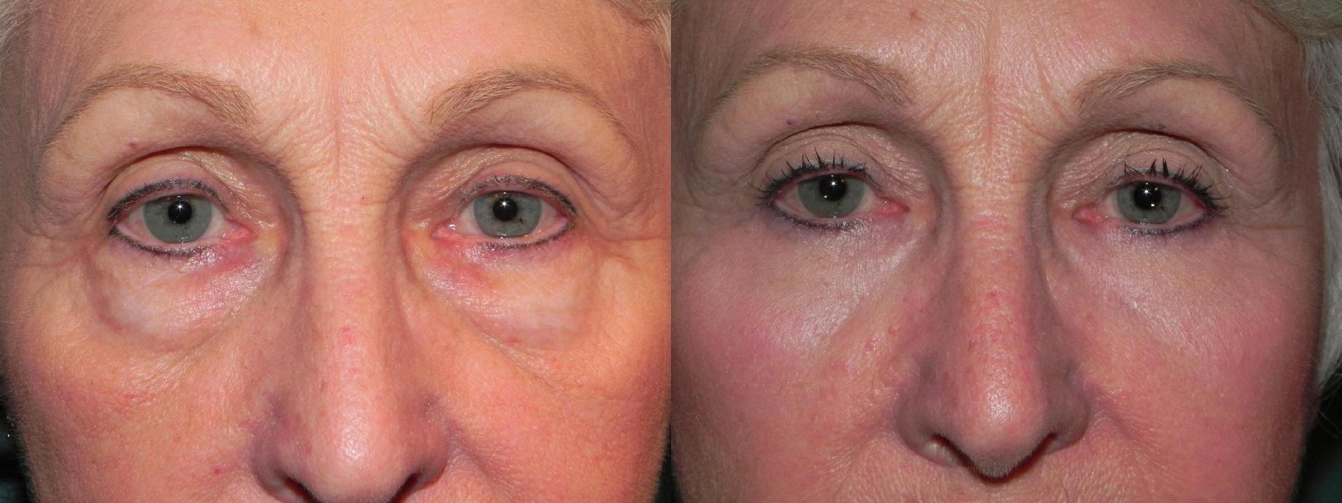 Adam Scheiner, MD eyelid lift result — Tampa, FL