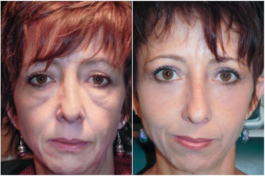 Adam Scheiner, MD laser treatment result — Tampa, FL