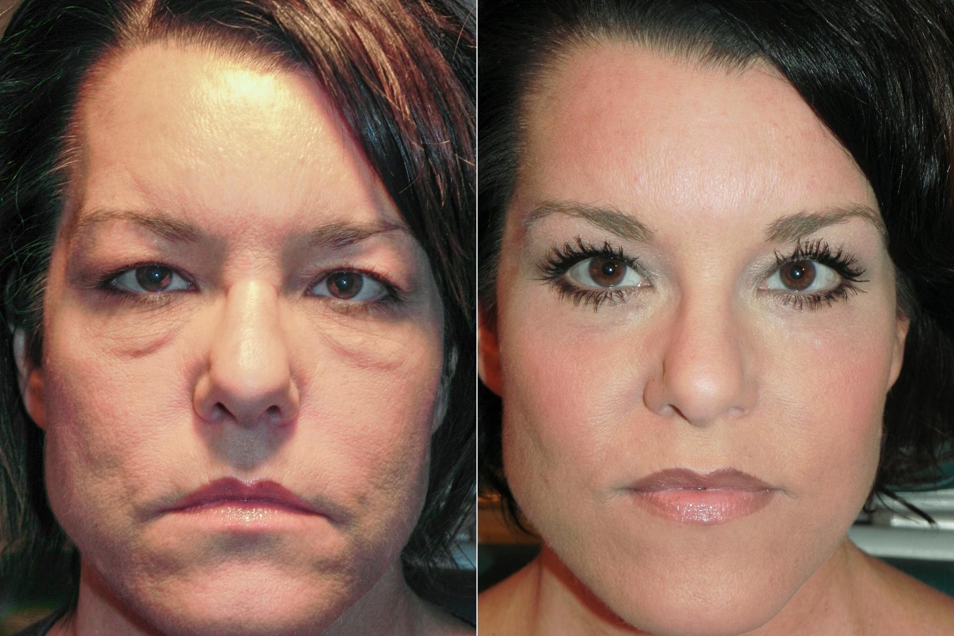 Adam Scheiner, MD laser treatment result — Tampa, FL