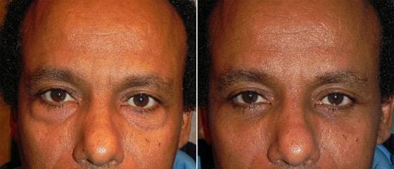 Adam Scheiner, MD eyelid lift result — Tampa, FL
