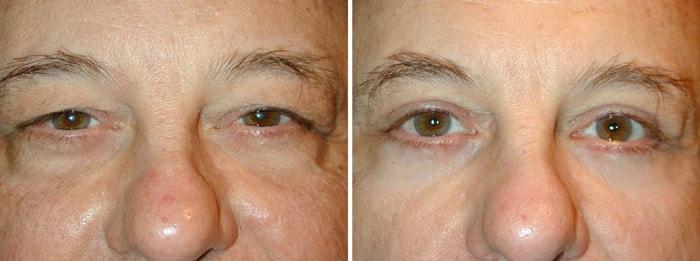 Adam Scheiner, MD eyelid lift result — Tampa, FL