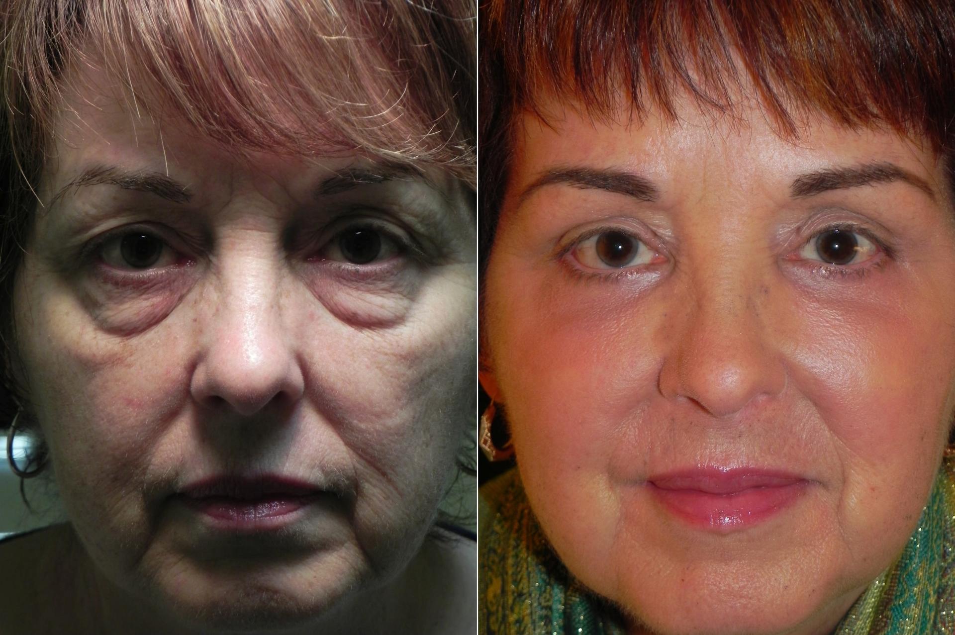 Adam Scheiner, MD laser treatment result — Tampa, FL