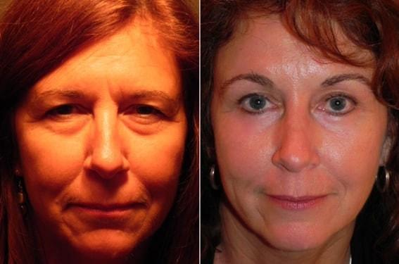 Brow Lift result at Adam Scheiner, MD in Tampa, FL