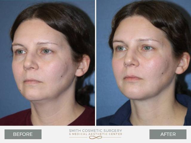 Neck Lift result at Smith Cosmetic Surgery in Centennial, CO