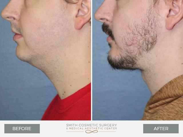 Chin Implant result at Smith Cosmetic Surgery in Centennial, CO