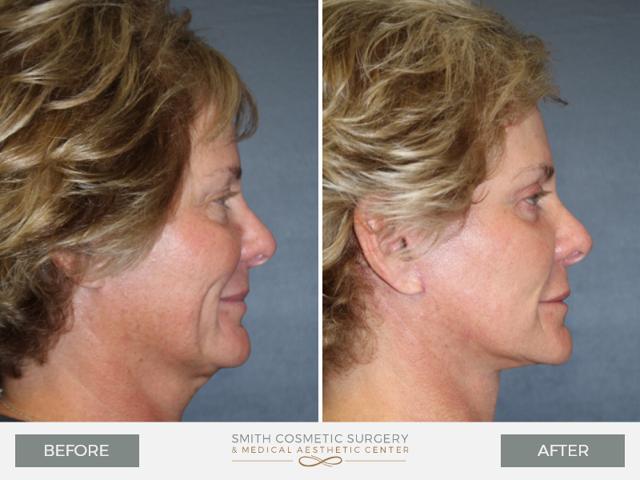Facelift result at Smith Cosmetic Surgery in Centennial, CO